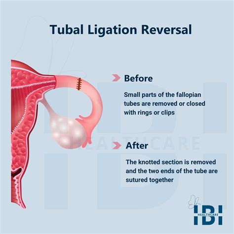 This Simple Procedure Can Make Tying Fallopian Tubes Reversible!
